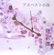 アスベスト小体